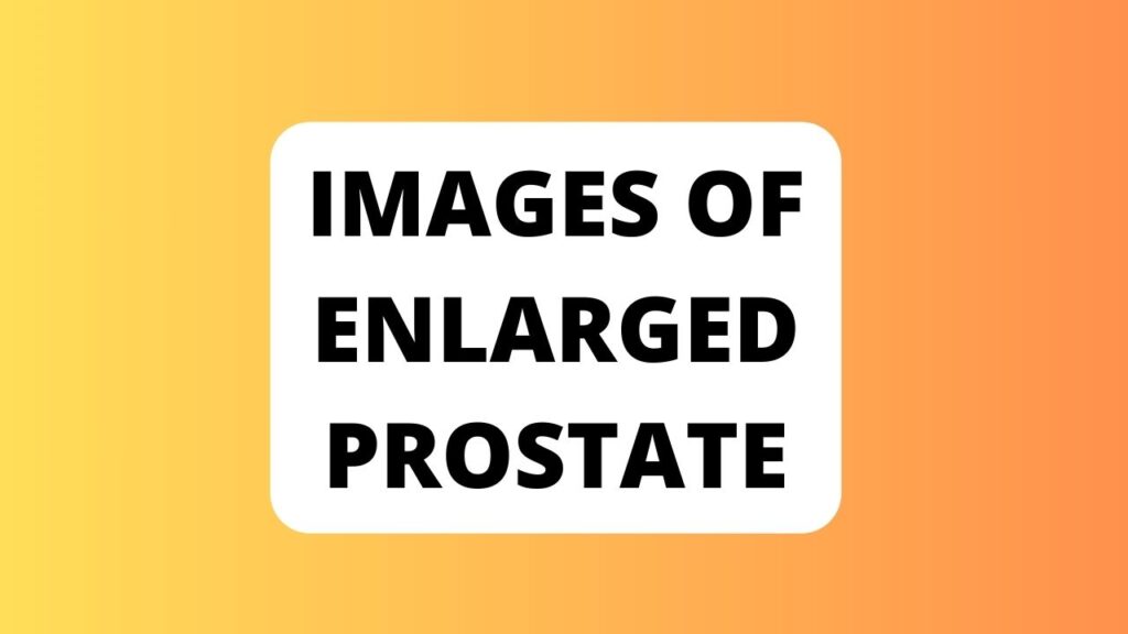 Images of Enlarged Prostate
